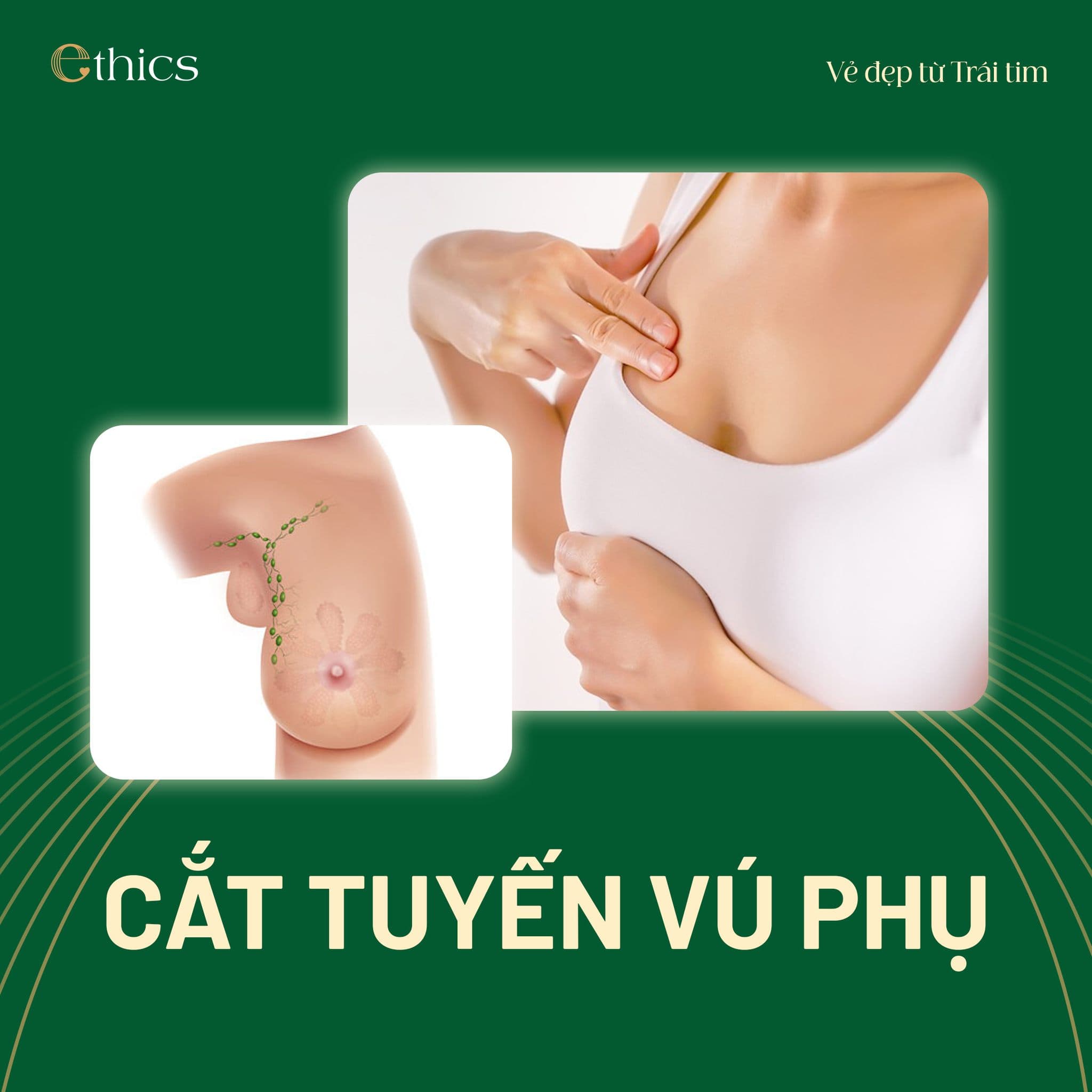 Accessory Breast Tissue Removal