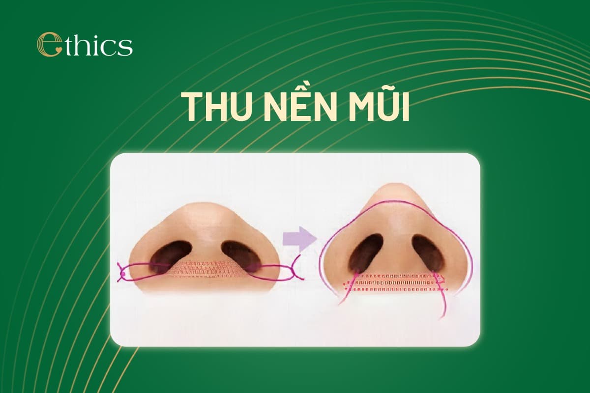 Nasal bridge augmentation