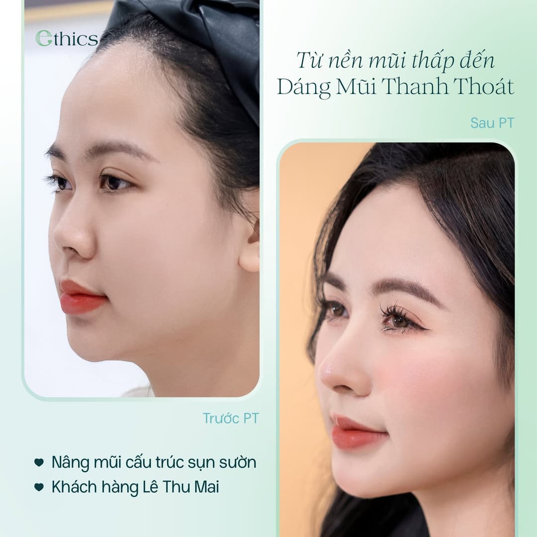 Image of a structural rib cartilage rhinoplasty case of Le Thu Mai, published by Ethics on 20/09/2026