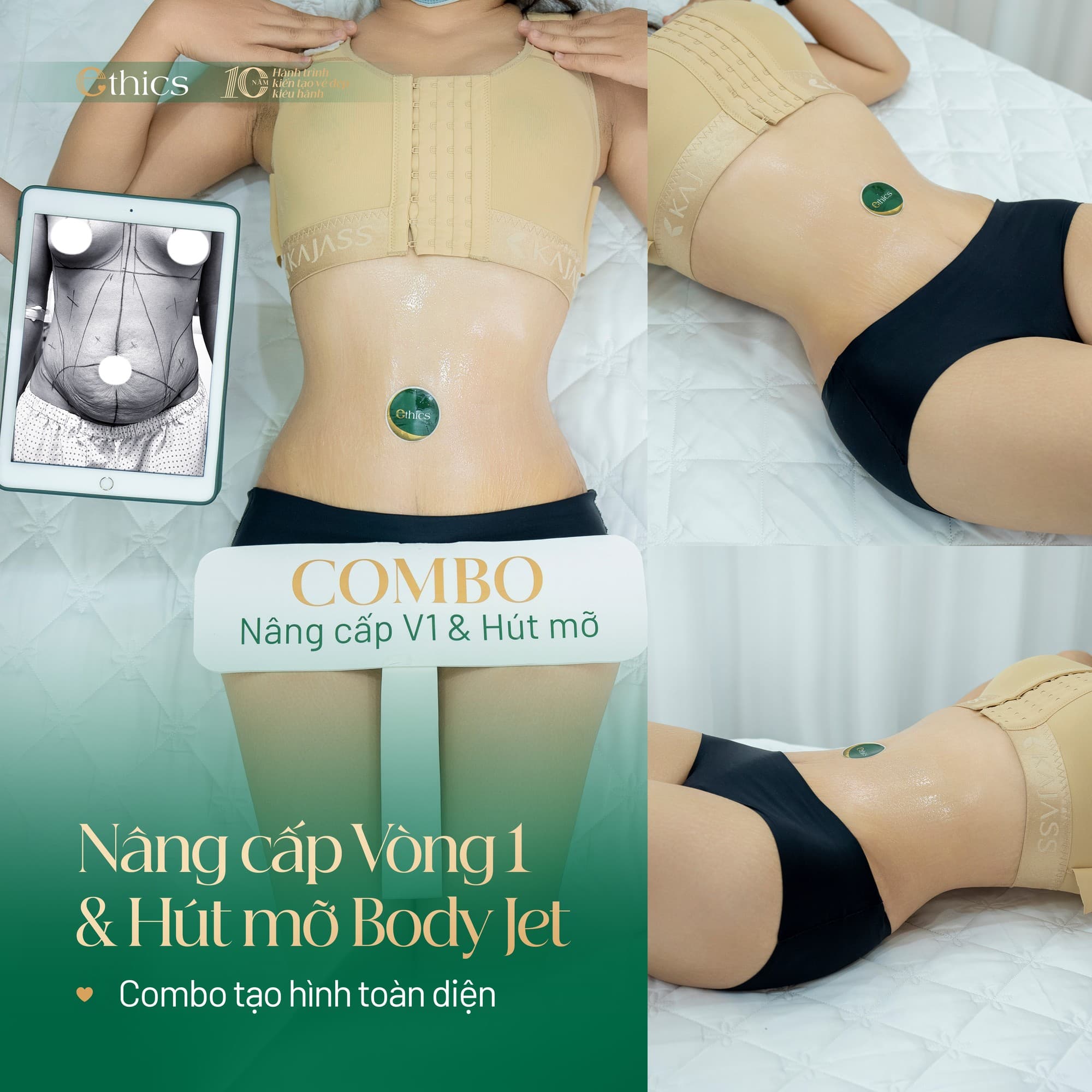 Breast implant removal
