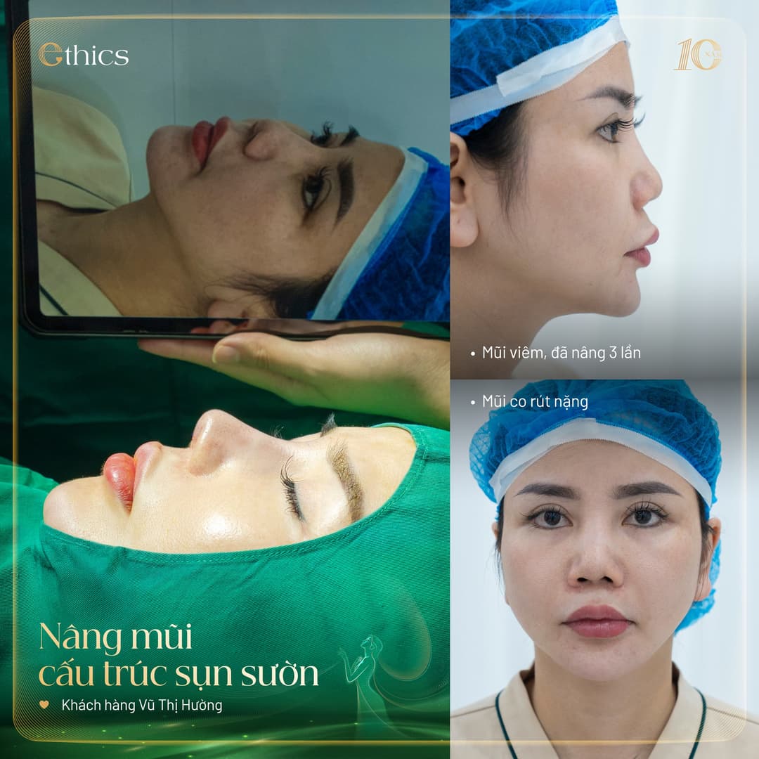 Ethics self-donated cartilage grafting for nasal reshaping