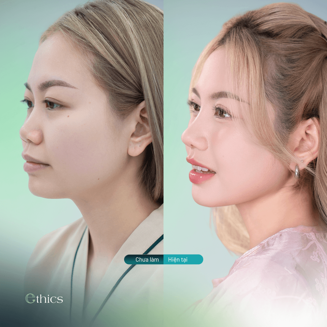Before and after comparison image of a patient's rhinoplasty