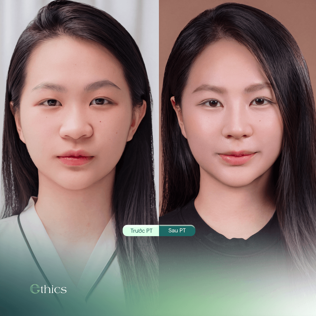 Here are before-and-after photos showing the results of a structured rhinoplasty procedure performed on a client
