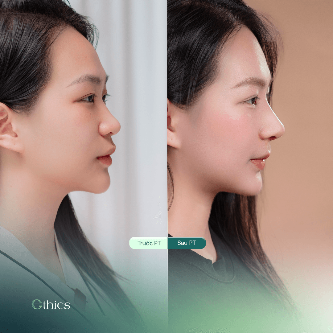 Side-profile before and after comparison image of the patient's rhinoplasty