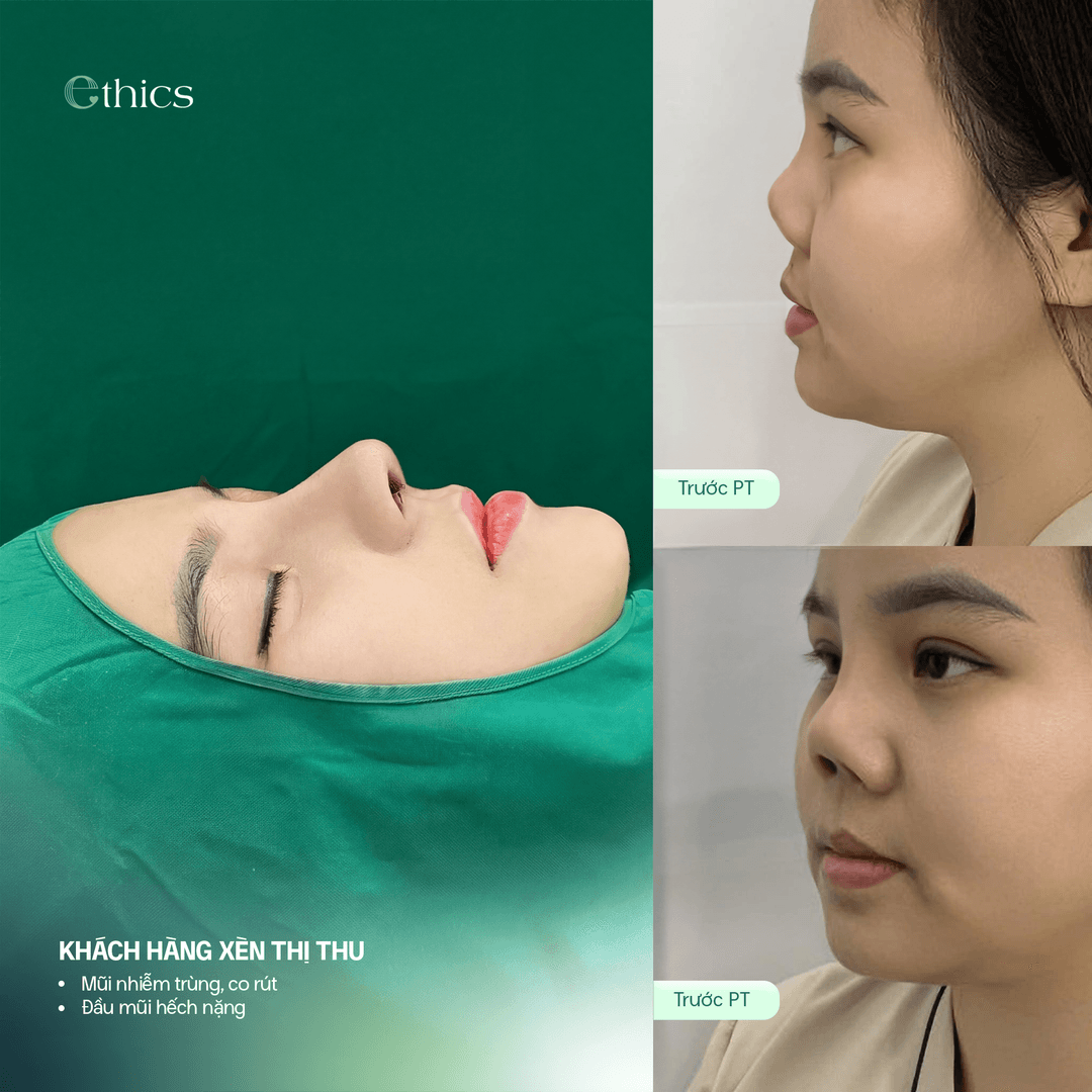 Before image of the patient's structural rhinoplasty