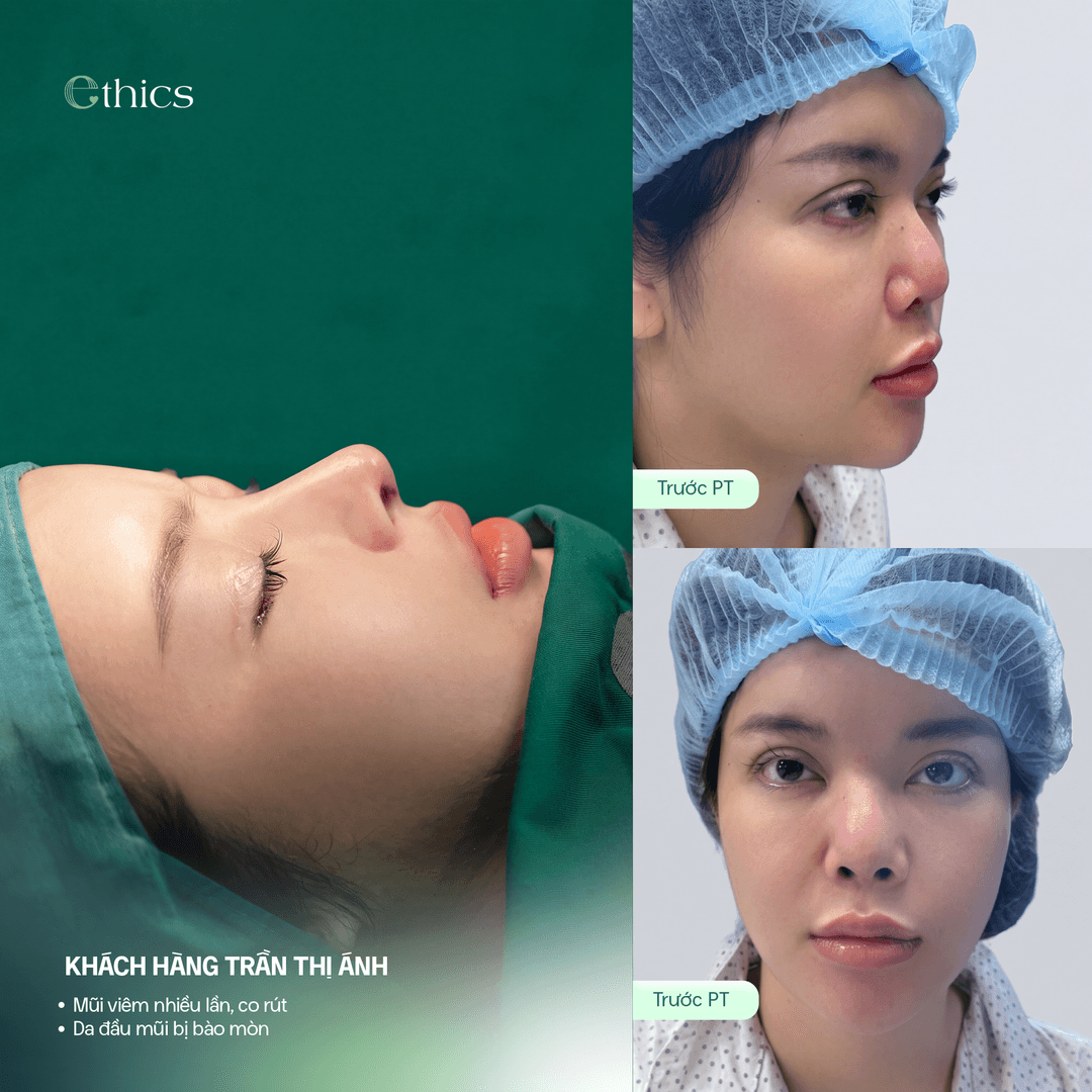 Patient image before rib cartilage structural rhinoplasty