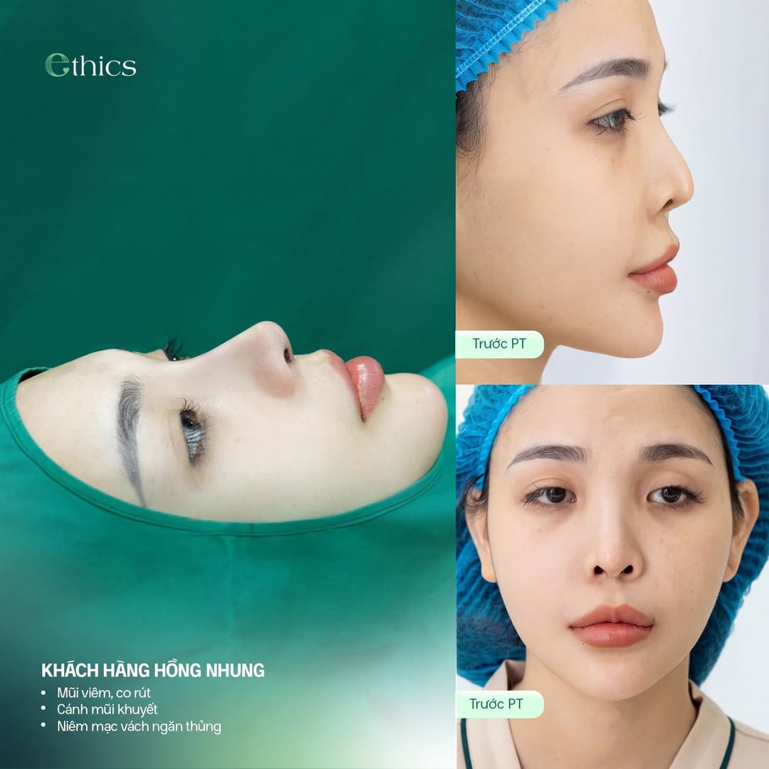 Image from an Ethics post: patient Hong Nhung, labeled "Inflamed, contracted nose", "Missing nostril wing" and "Perforated septal mucosa", with two images marked Before surgery