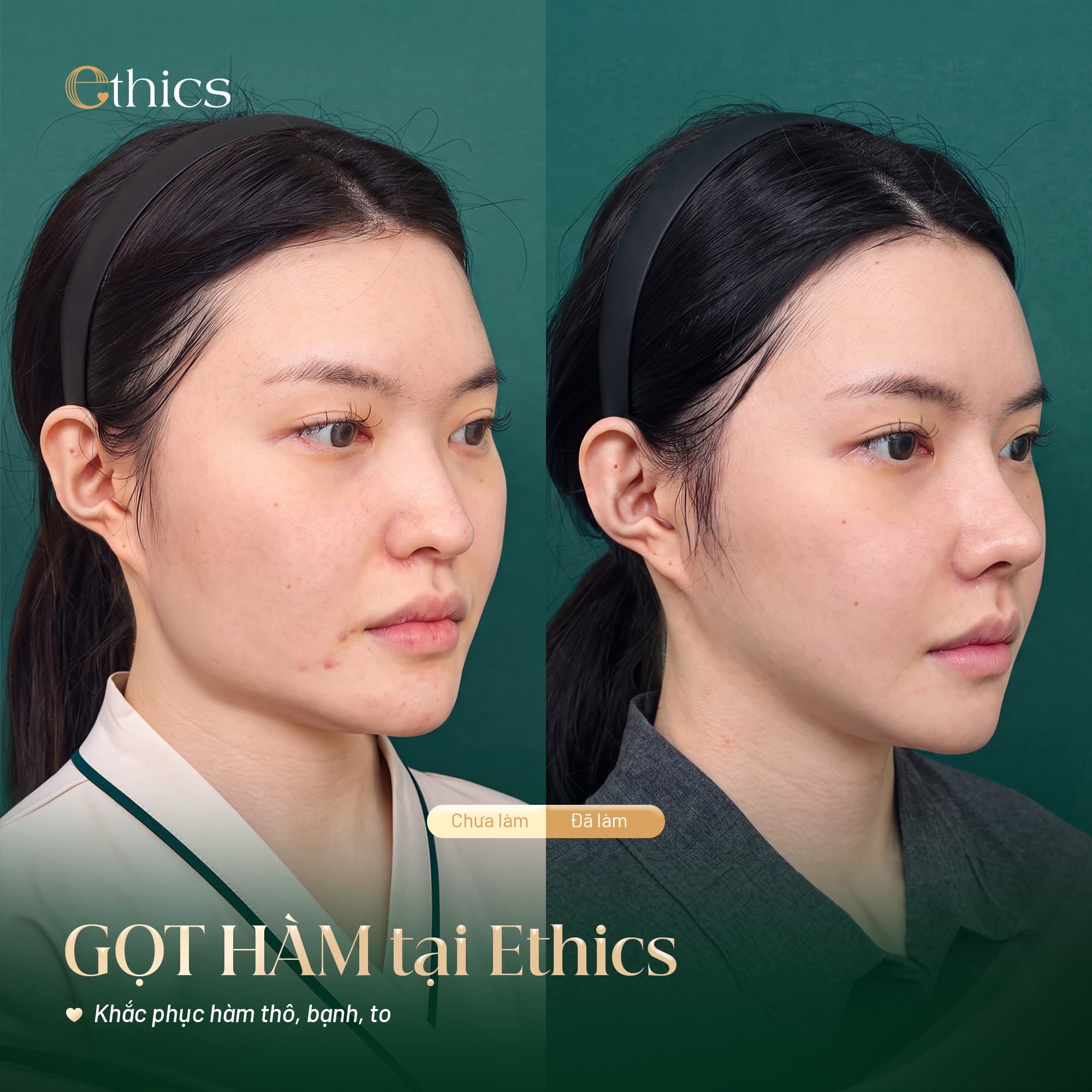 Jaw Contouring Surgery