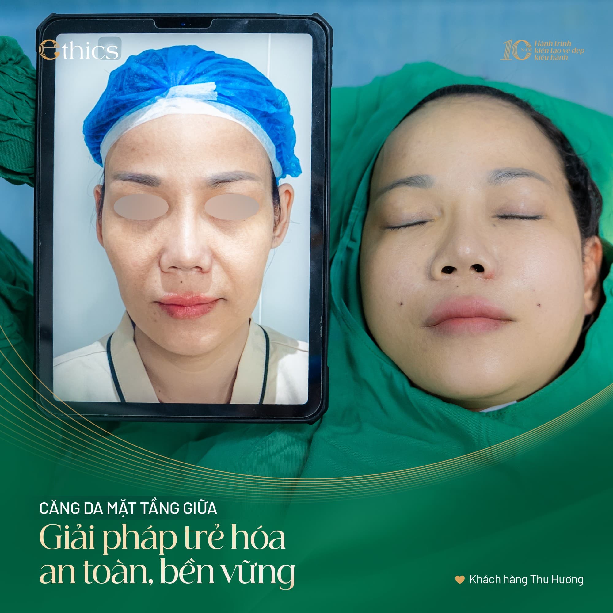 Jaw angle reduction surgery + skin tightening