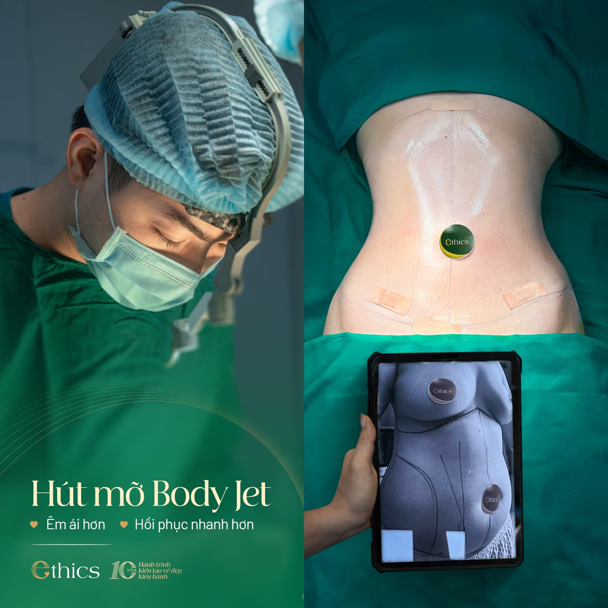Body Jet liposuction