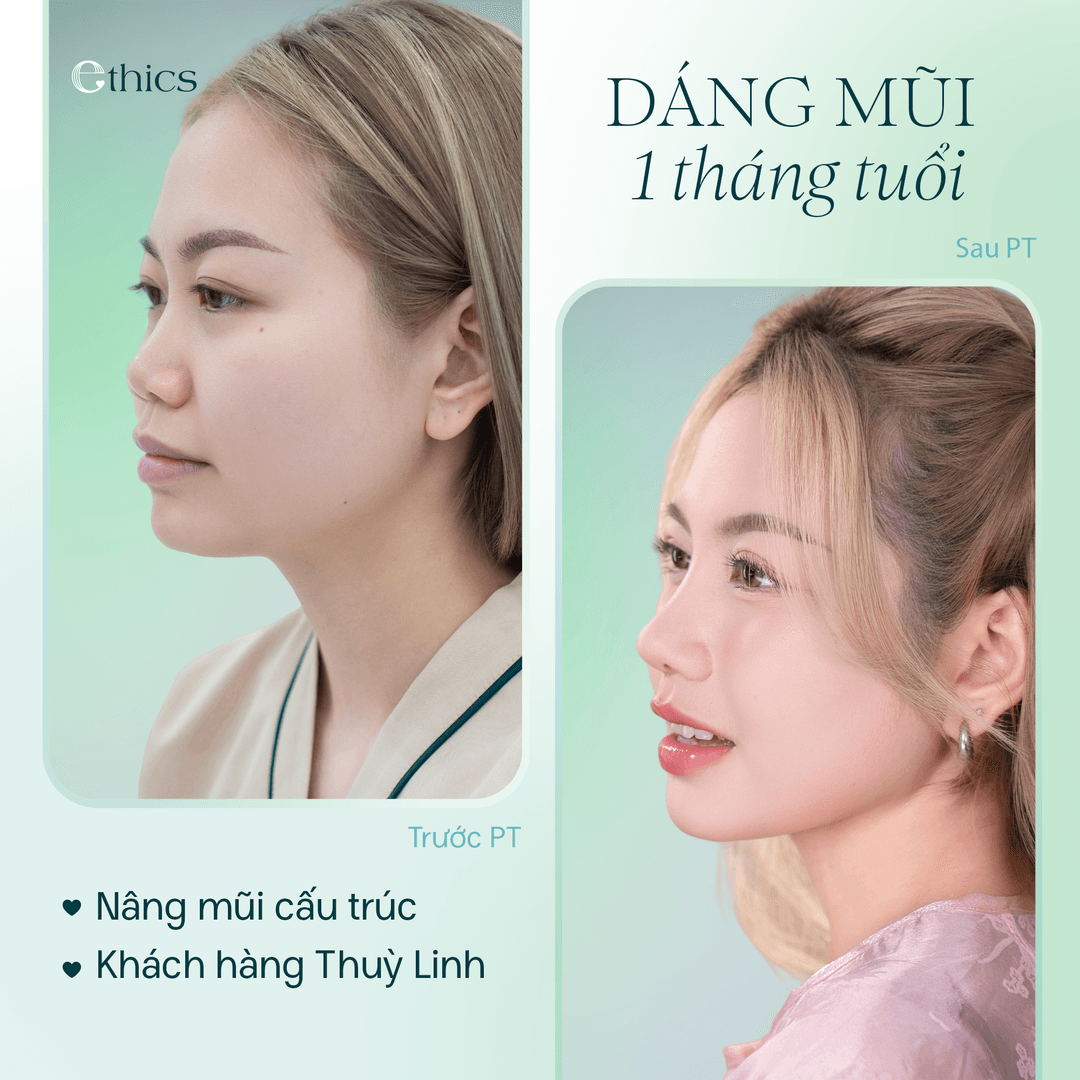 Before and after comparison image of the patient's structural rhinoplasty