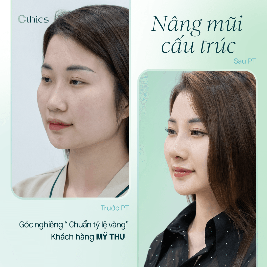 STRUCTURAL RHINOPLASTY - A NEW LOOK IN 10 DAYS